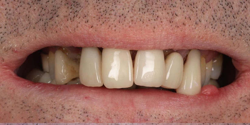 Multiple Implants before treatment